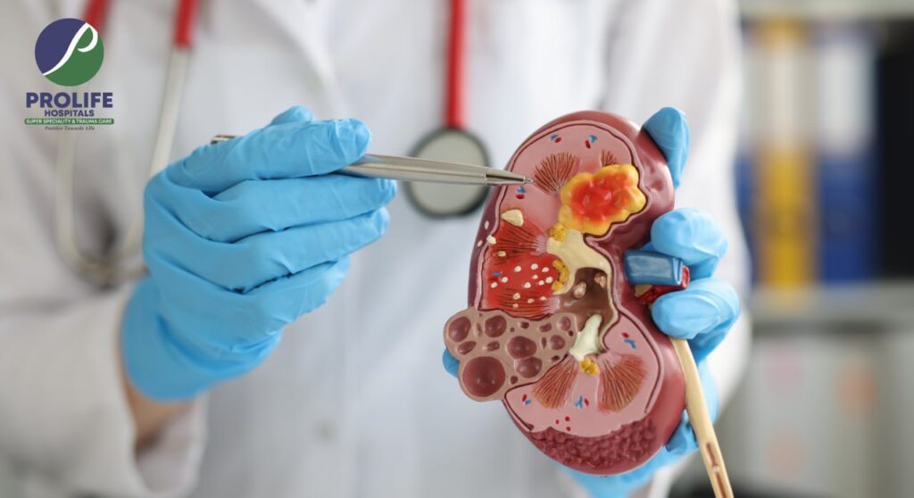 The Revolutionary Advancements in Laser Kidney Stone Removal at Prolife Hospitals
