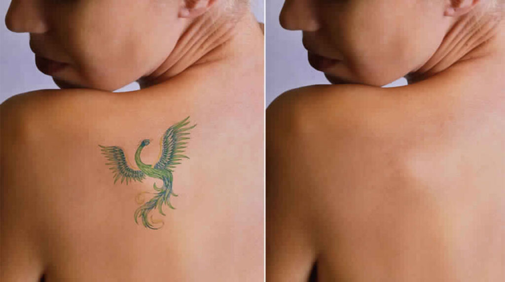 Tattoo Removal Market Size, Share, Growth, Trends 2024-2032