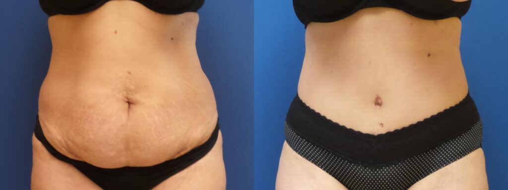 Transforming Lives: Premier Plastic Surgery’s Liposuction Before And After