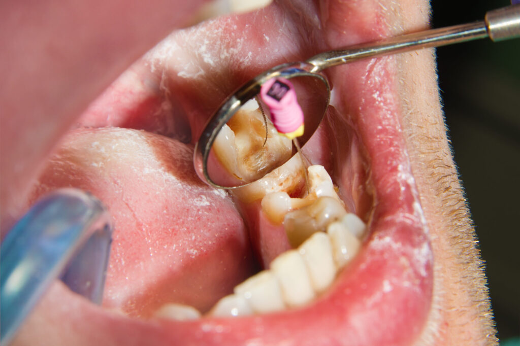 Why are Root Canals Recommended for Cases of Severe Tooth Infection or Damage?