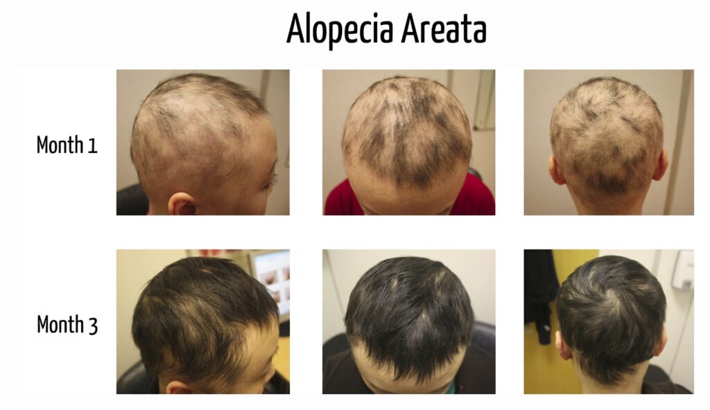 Reflections on Alopecia Areata: Patient Experiences and Triumphs