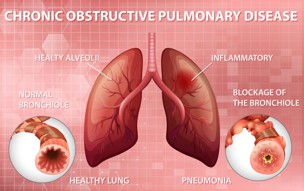 Growing Health-Related Concerns Bound to Push the Chronic Obstructive Pulmonary Disease Market Trends Forward