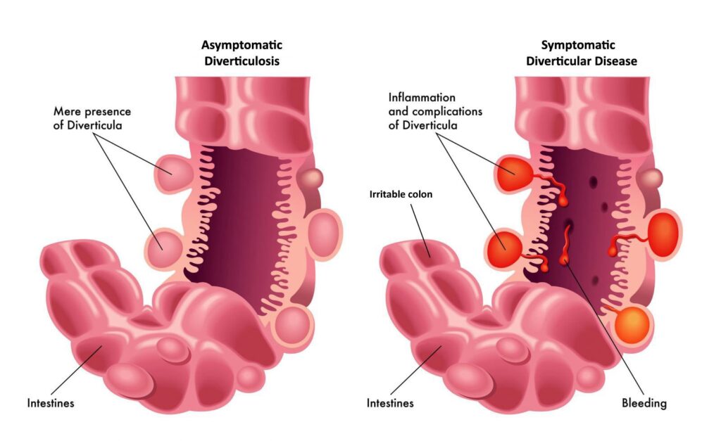 Regulatory Compliance Made Simple: A Guide for Diverticulitis Patients