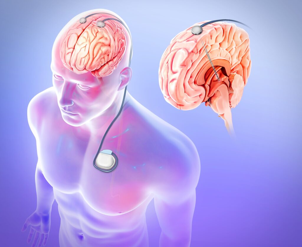 Global Epilepsy Surgery Market Research Shows Upsurge of the Industry with 5.72% CAGR during 2023-2030