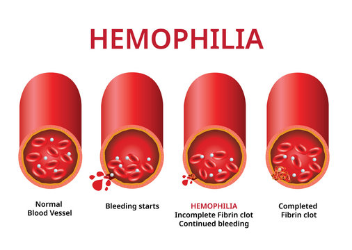 Living with Hemophilia: Coping Strategies and Quality of Life