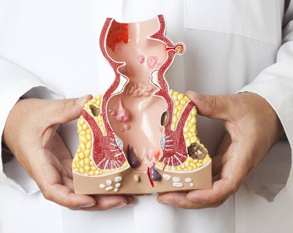 Global Hemorrhoid Treatment Devices Market Research on Registering CAGR In the Upcoming Years