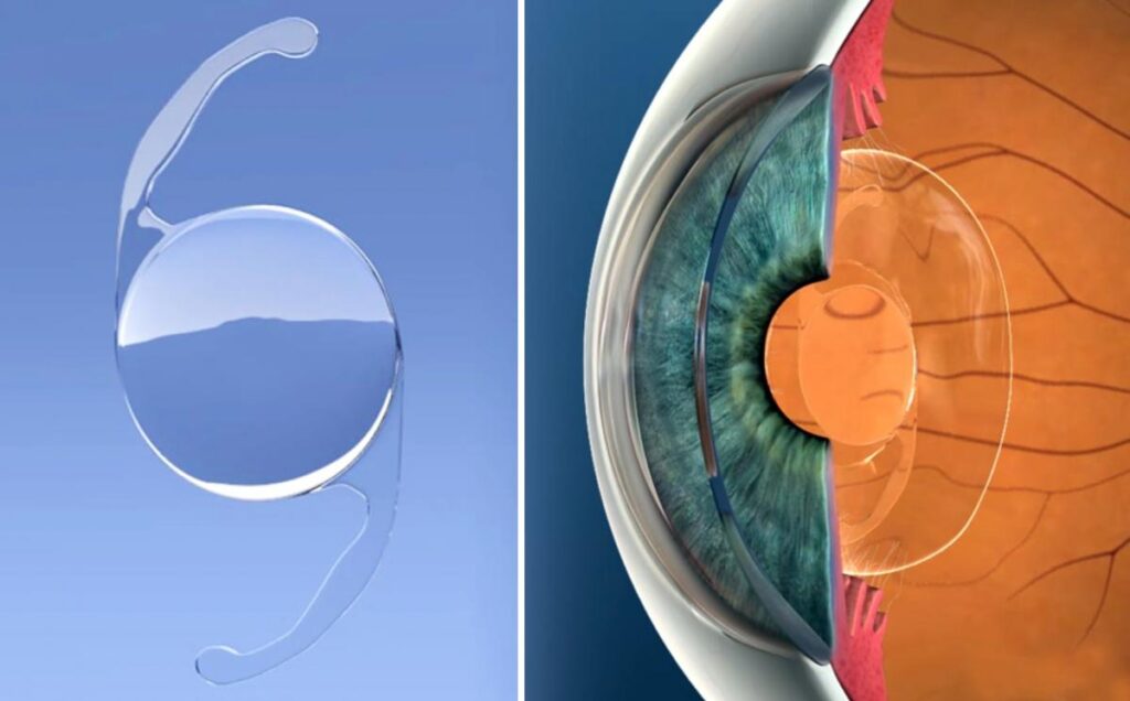 Global Intraocular Lens Market Research Reveals a Surging CAGR; Asserts MRFR