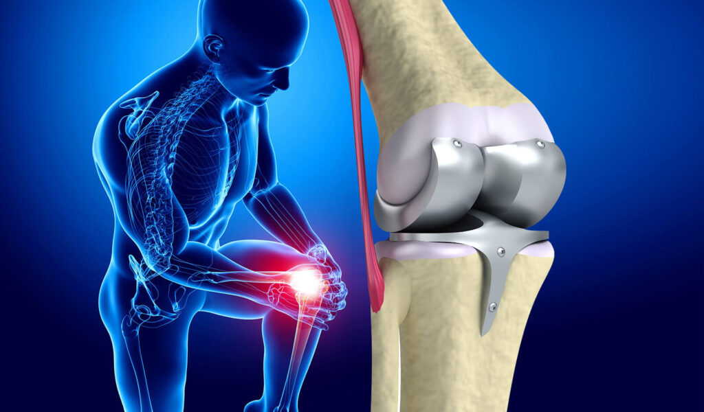 Knee Replacement Market Trends to Register Striking Growth As Manufacturers Bring New Innovative Products to Downstream Processes