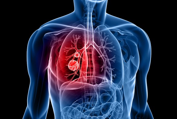 Consulting for Change: Understanding Lung Cancer Symptoms and Analysis