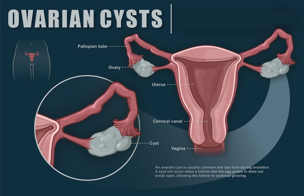 Global Ovarian Cysts Market Trends to be Led by North America During Review Period