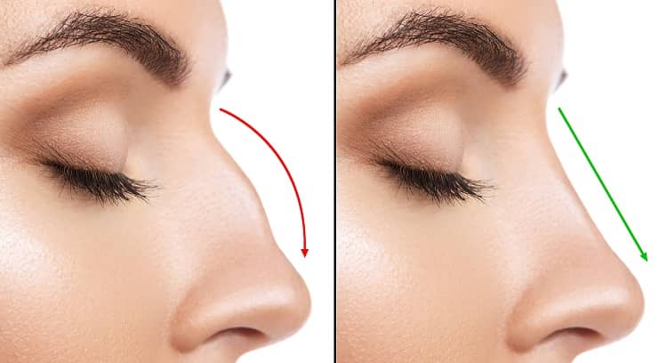 WHAT RESULTS CAN AN ETHNIC RHINOPLASTY ACHIEVE?