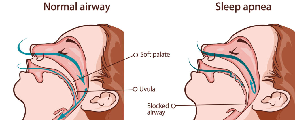 Sleep Apnea Device Market Trends includes Global Industry Size & Forecasts
