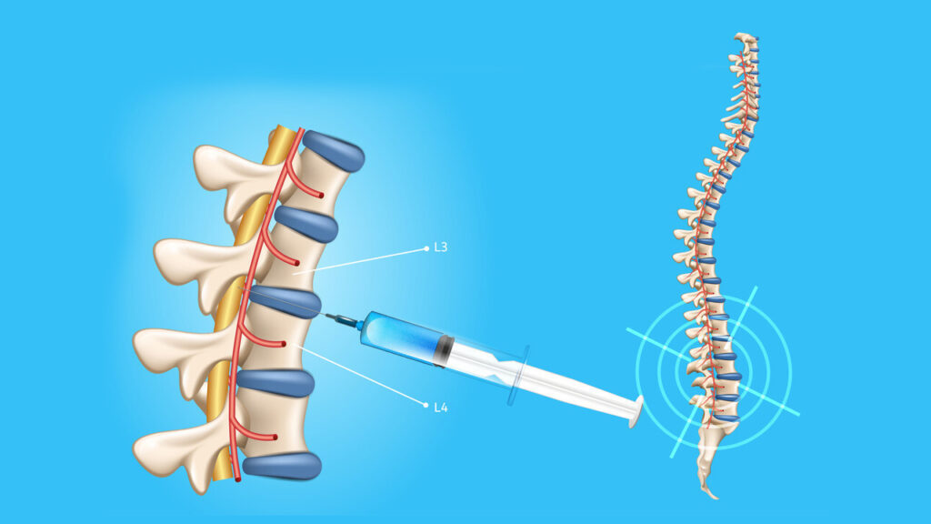 A Change in Treatment Practice Will Preserve Current Spinal Needles Market Trends