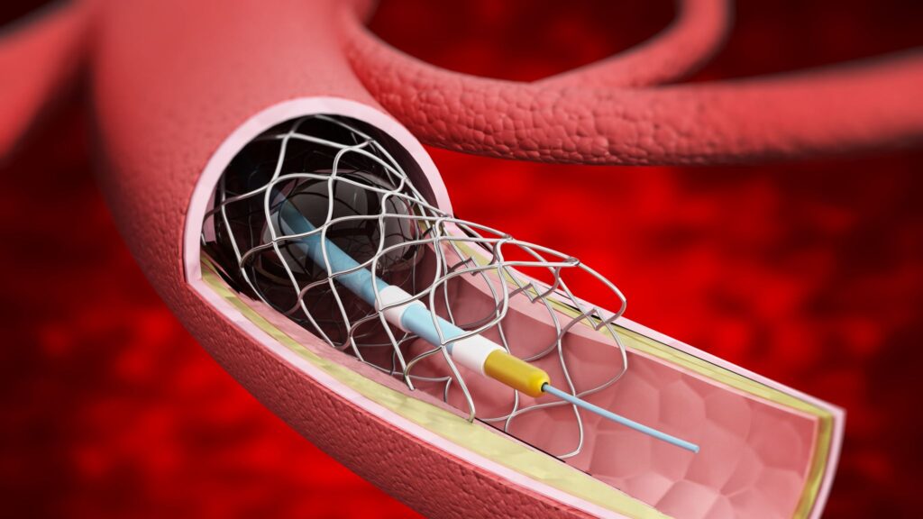Vascular Stents Market Research Shows Growth with A Whopping CAGR; Declares MRFR