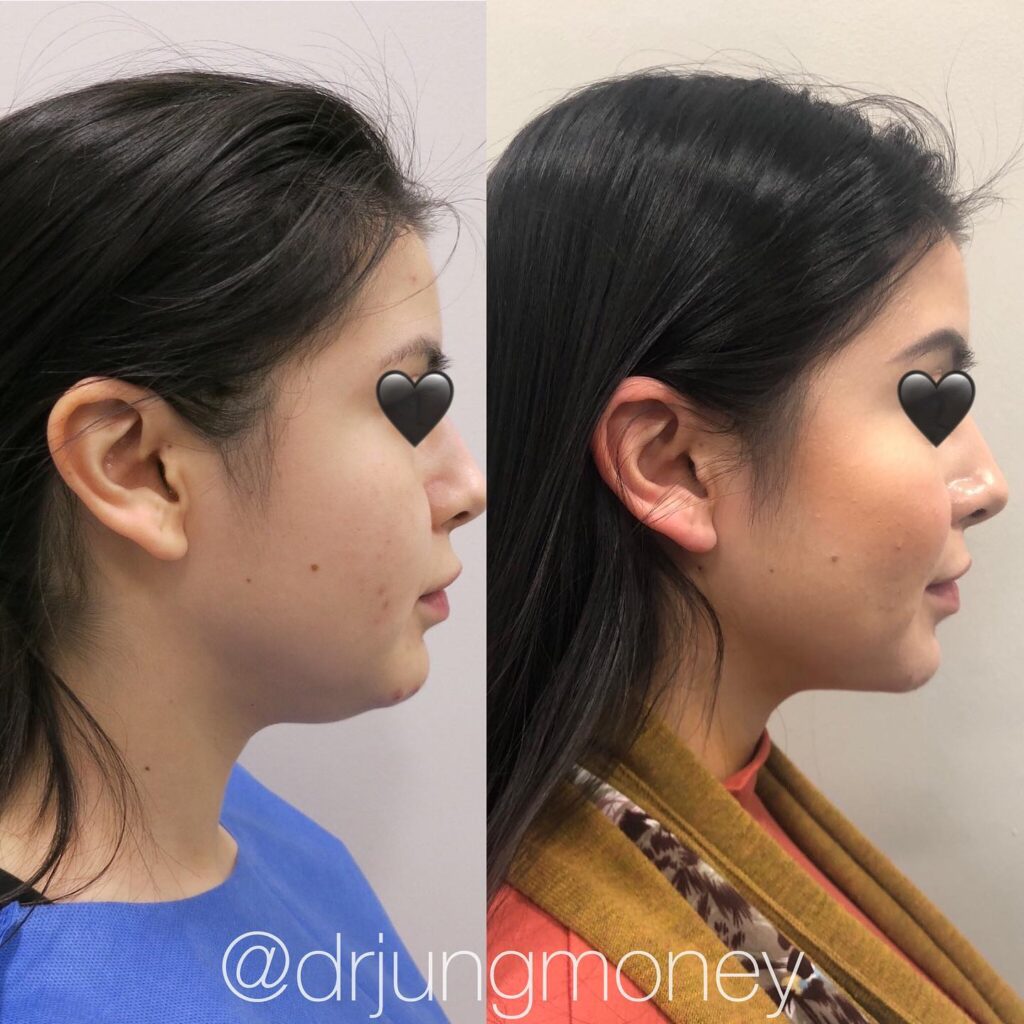 The Comprehensive Guide To Eye Lift Surgery: Costs, Benefits, And Recovery