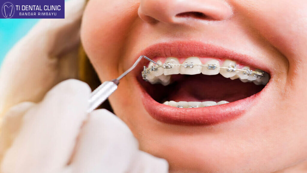 Dental Braces: Your Path to Confidence and Oral Health (Tidental)