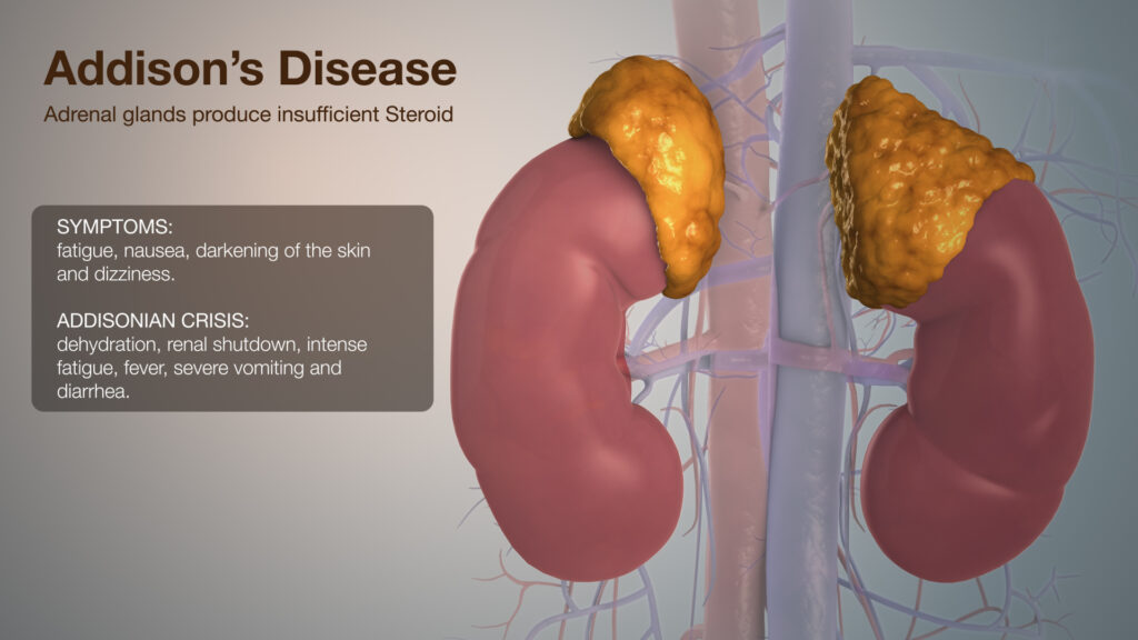 Autoimmune Addison Disease: Trailblazing Towards Enhanced Patient Care
