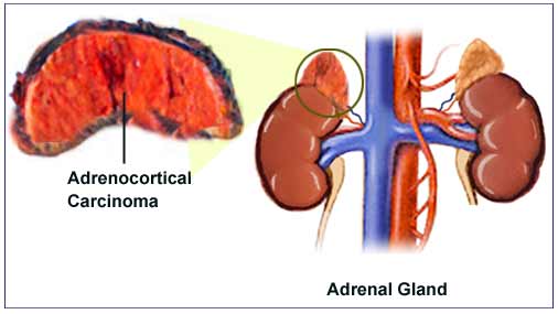 Adrenocortical Carcinoma: Services Enhancing Treatment Through Cutting-Edge Research | DLI