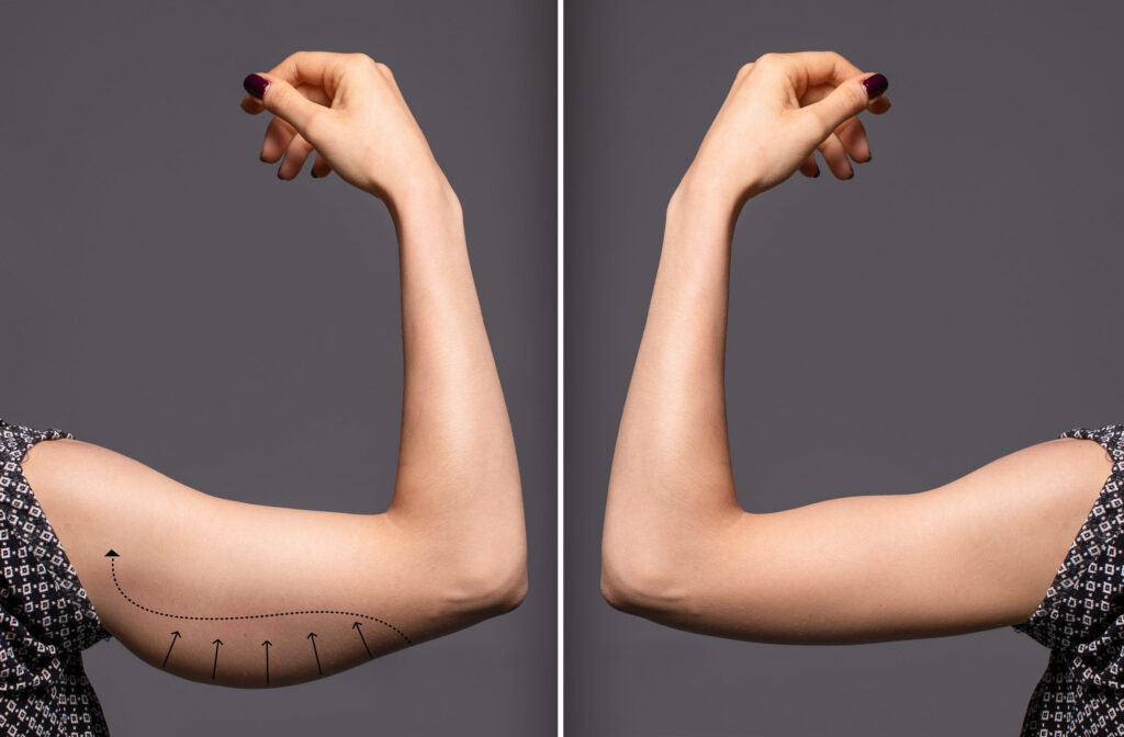Is Arm Liposuction Or Cheek Reduction Surgery Right For You?