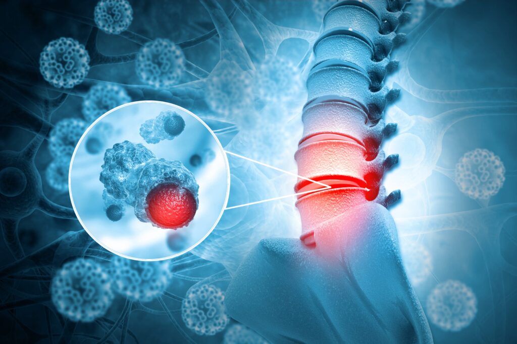 Beyond the Surface: Research Analysis of Bone Cancer Trends | DLI