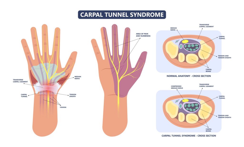Treatment Evolution: Navigating the Latest Advances in Carpal Tunnel Syndrome Care | DLI