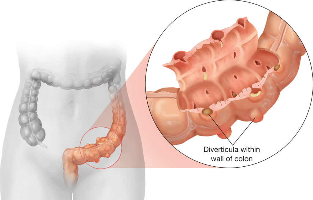 Market Insights: Diverticulitis Research Trends and Outlook | DLI