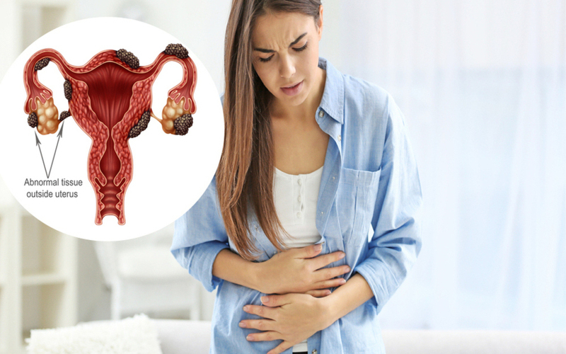 What Are The Signs of Endometriosis?