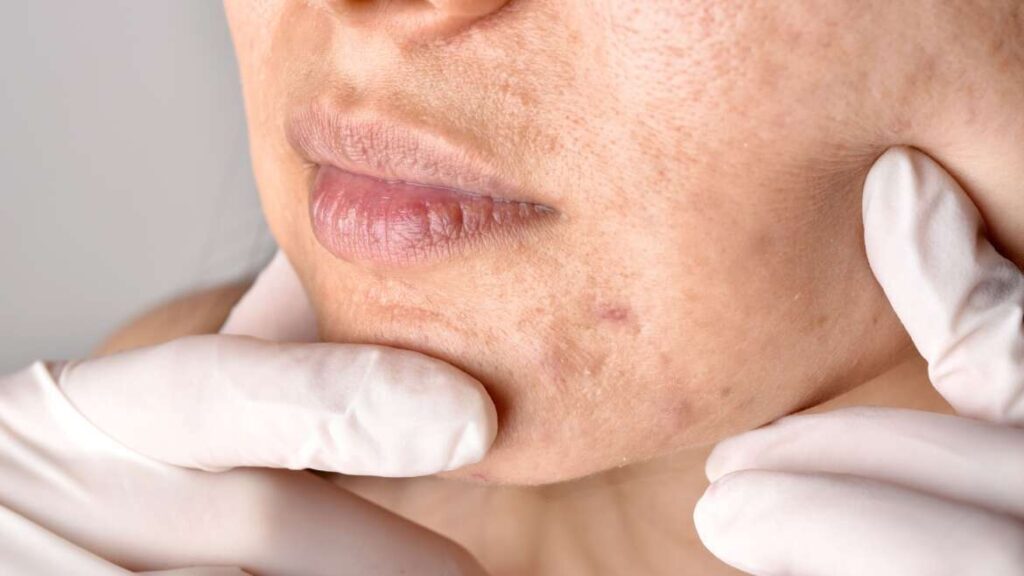Dubai’s Fast-Track Clear Skin