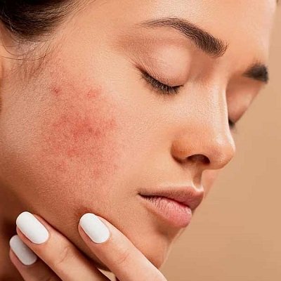Dubai’s Fast-Track Clear Skin