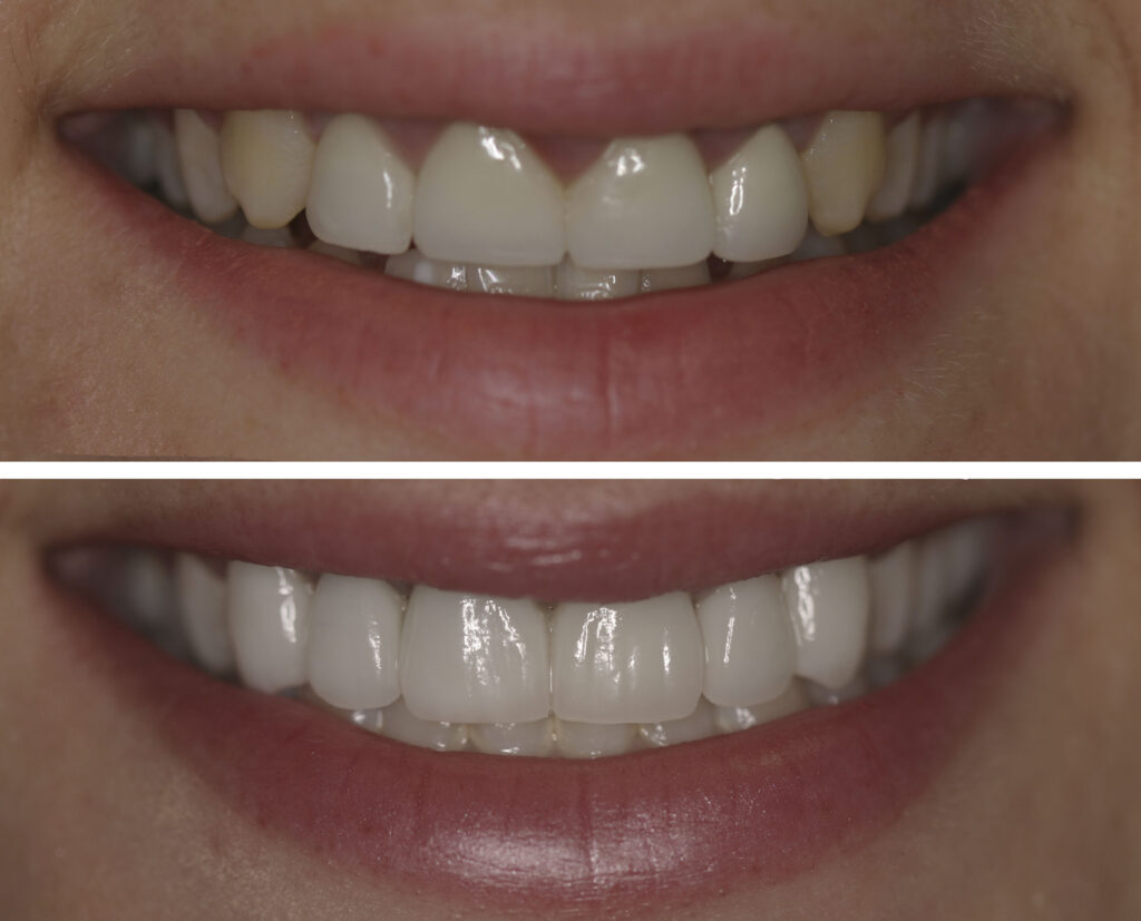 What Are The Advantages Of Teeth Bonding Before And After Emergency Dental Implant?