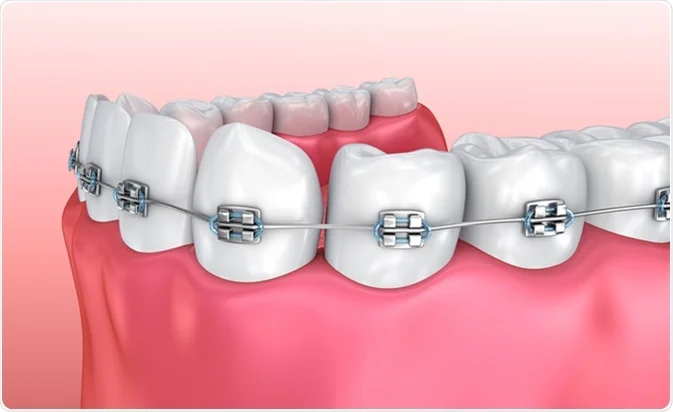 What are the Best Braces to Straighten Teeth?