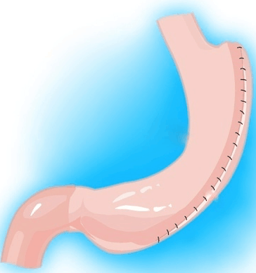 Sculpting Success: Gastric Plication Solutions in Dubai