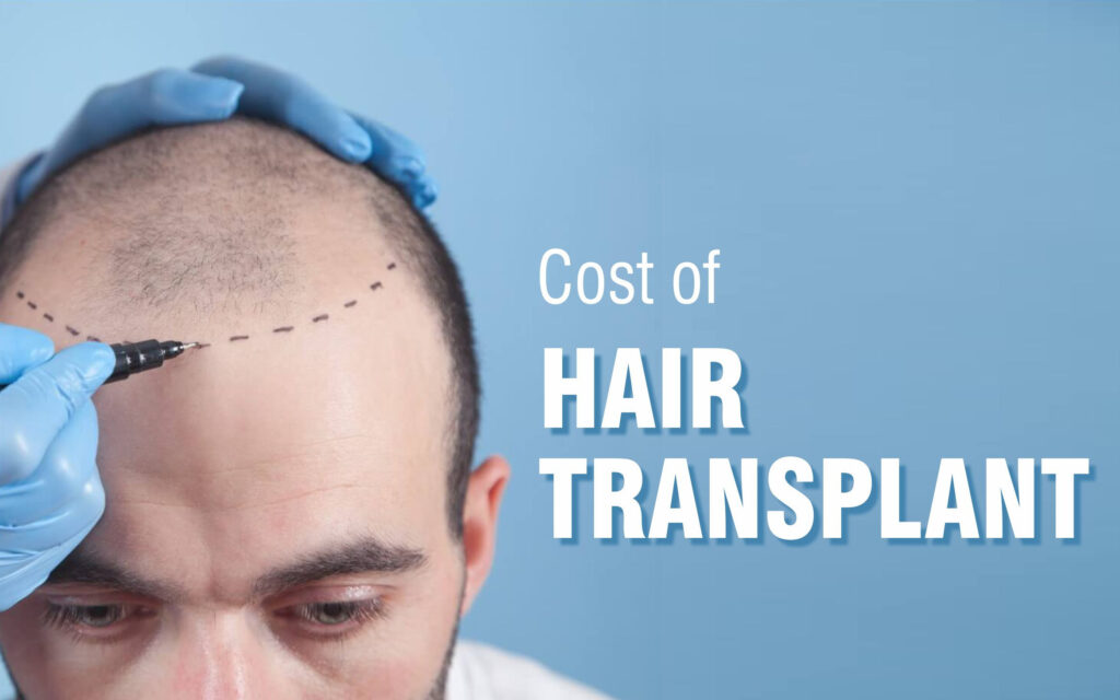 An Extensive Guide To Hair Transplant Aftercare & Recovery