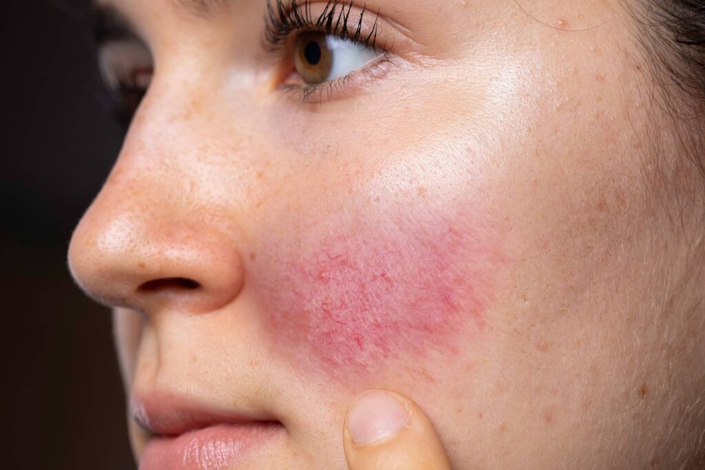 Navigate Rosacea Challenges with Dubai’s Expertise