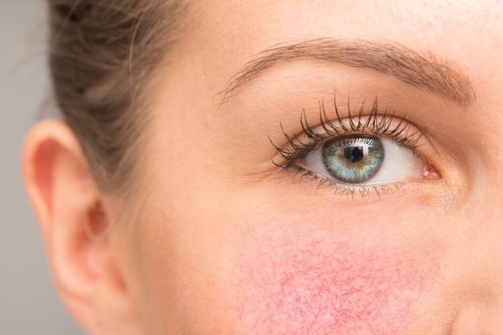 Camouflaging Techniques for Rosacea-Induced Redness