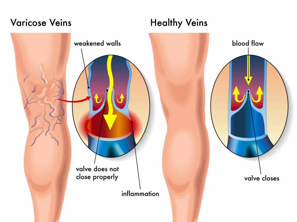 Vein Vigilance: A Comprehensive Expedition into Varicose Vein Solutions